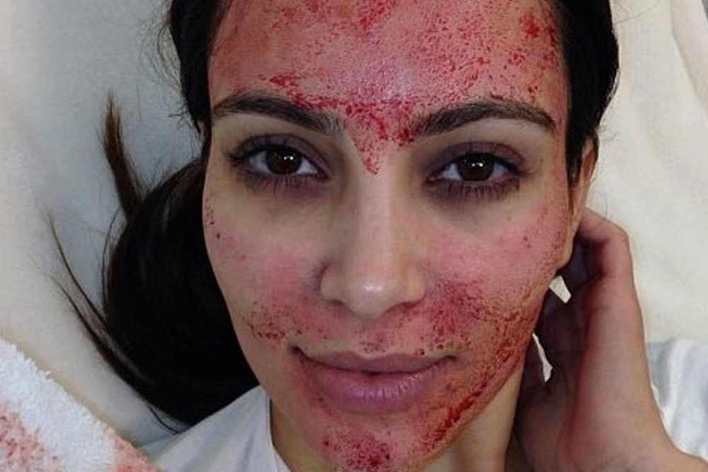 Vampire Facial For Hair Growth